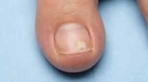 arly signs of toenail fungus showing small white-yellow discoloration on the big toenail