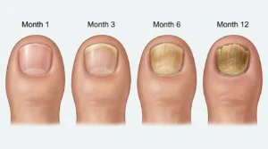 Timeline showing toenail fungus progression from early yellow discoloration to advanced thick damaged nail when left untreated