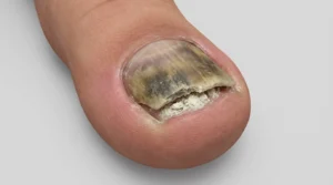 Advanced toenail fungus with debris accumulation under nail showing signs that cause nail odor