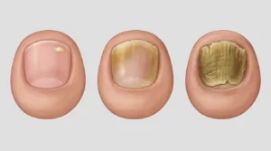 Three toenails showing Stage 1, Stage 2, and Stage 3 toenail fungus progression side by side
