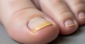 Elderly toenail with early signs of toenail fungus, showing mild yellow discoloration and thickening, photographed in a clinical dermatology reference style.