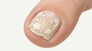 White chalky toenail fungus showing dry crumbly patches and powdery texture on the nail surface