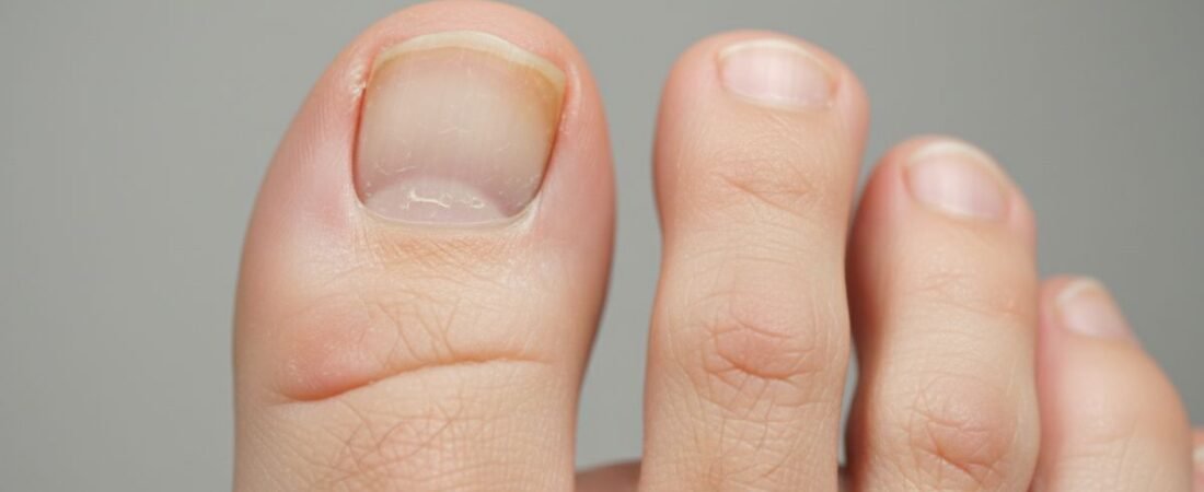 Stages of Toenail Fungus: How the Infection Progresses Over Time