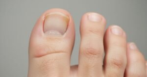 Toenail fungus infection showing early yellow discoloration on the nail.