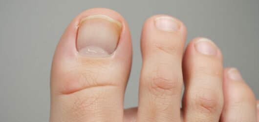 Stages of Toenail Fungus: How the Infection Progresses Over Time