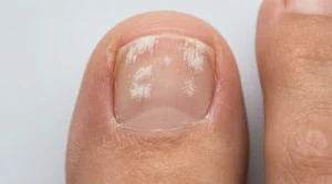 Close-up of white toenail fungus showing powdery white patches and chalky texture on the nail surface